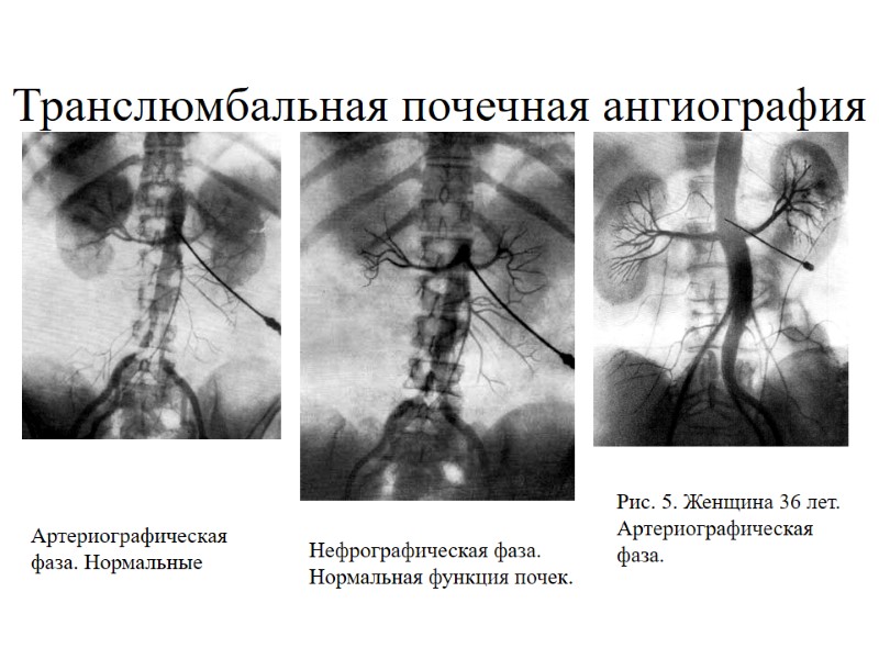 Транслюмбальная почечная ангиография Рис. 3.Мужчина 39 лет. Артериографическая фаза. Нормальные почечные артерии и их